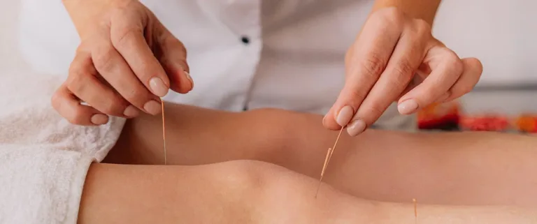 Acupuncture for Stress and Anxiety: The Ultimate Guide