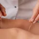 Acupuncture for Stress and Anxiety: The Ultimate Guide