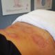 Sports Recovery Acupuncture: 6 Key Benefits You Should Know
