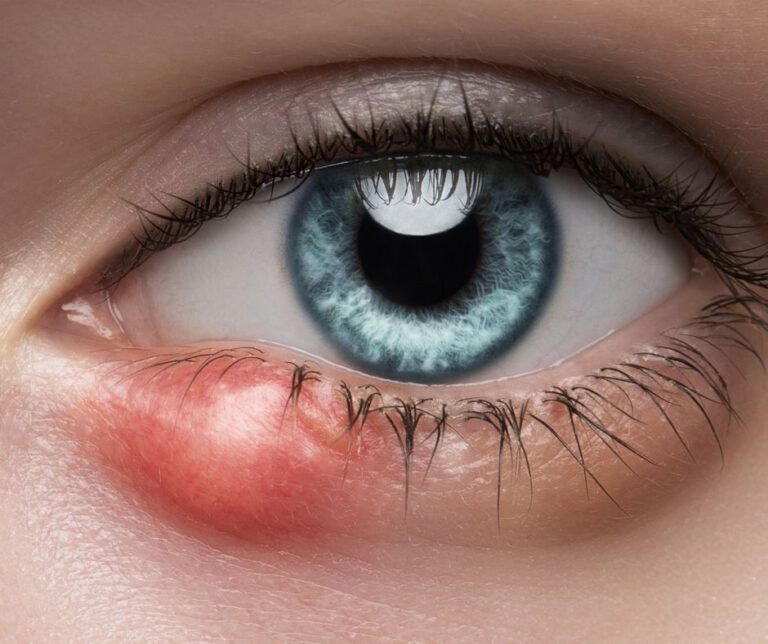 Eye Styes: Effective Home Remedies for Quick Relief