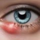 Eye Styes: Effective Home Remedies for Quick Relief